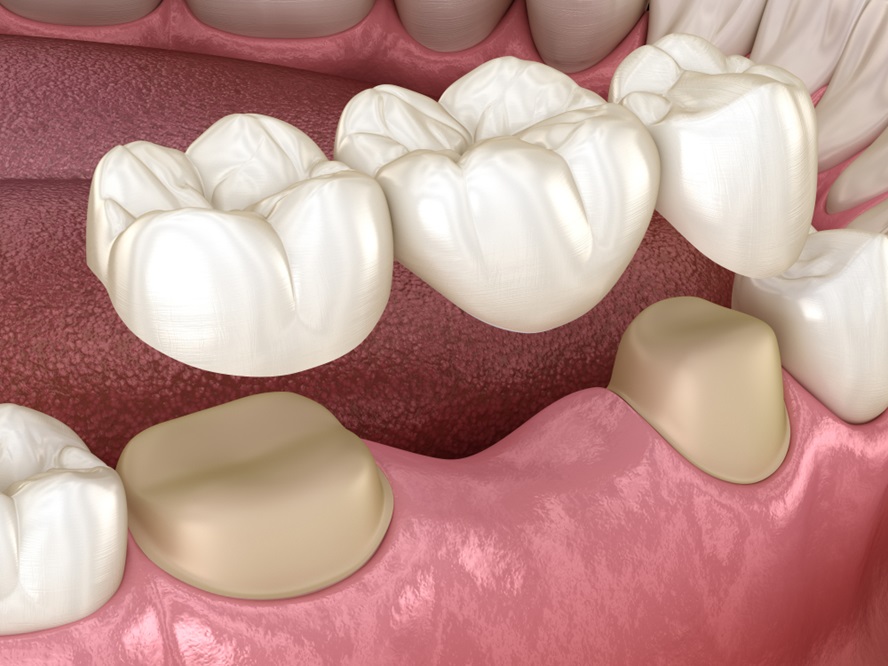 Dental Bridges Your Comprehensive Guide