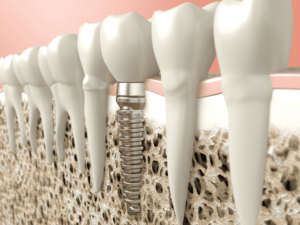 Dental Implants Can Help You Regain Your Confidence and Smile