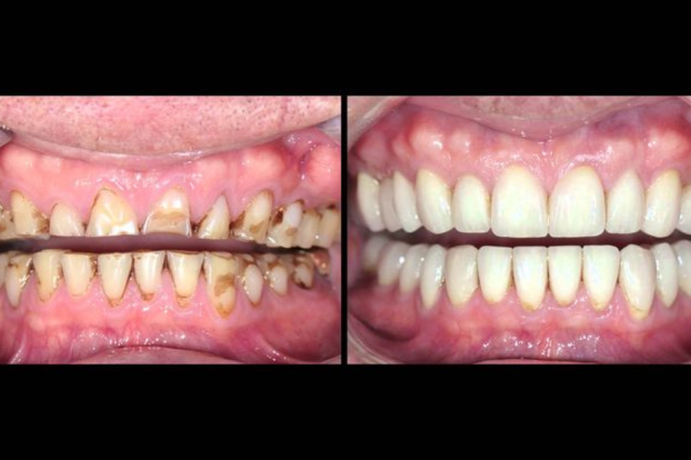 Enhance Your Confidence with Full Mouth Restoration Procedures