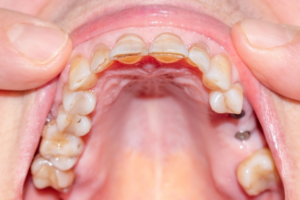 Exposed Dentin Prevention and Treatment